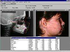 Compu-Ceph (Ver 2.0) Cephalometric Analysis